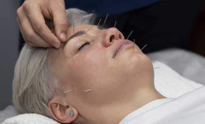New Covered Service | Facial Cosmetic Dry Needling